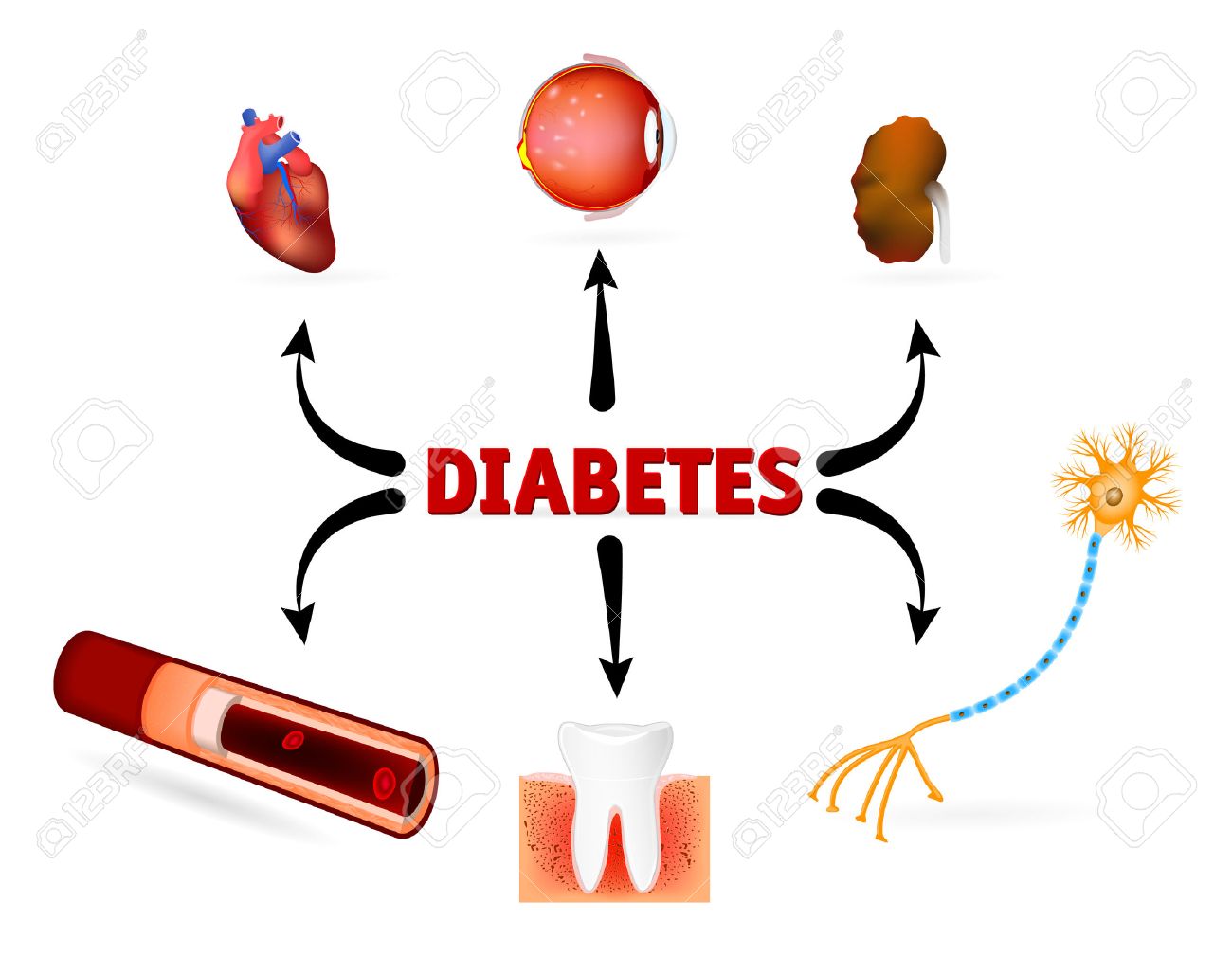 diabetes et maladies